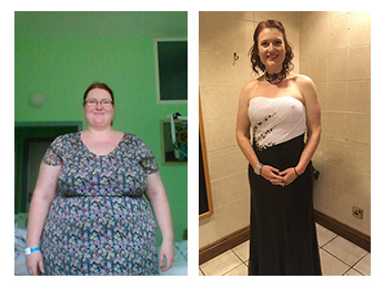 Becky - Gastric Sleeve - New Leaf Weight Loss Surgery